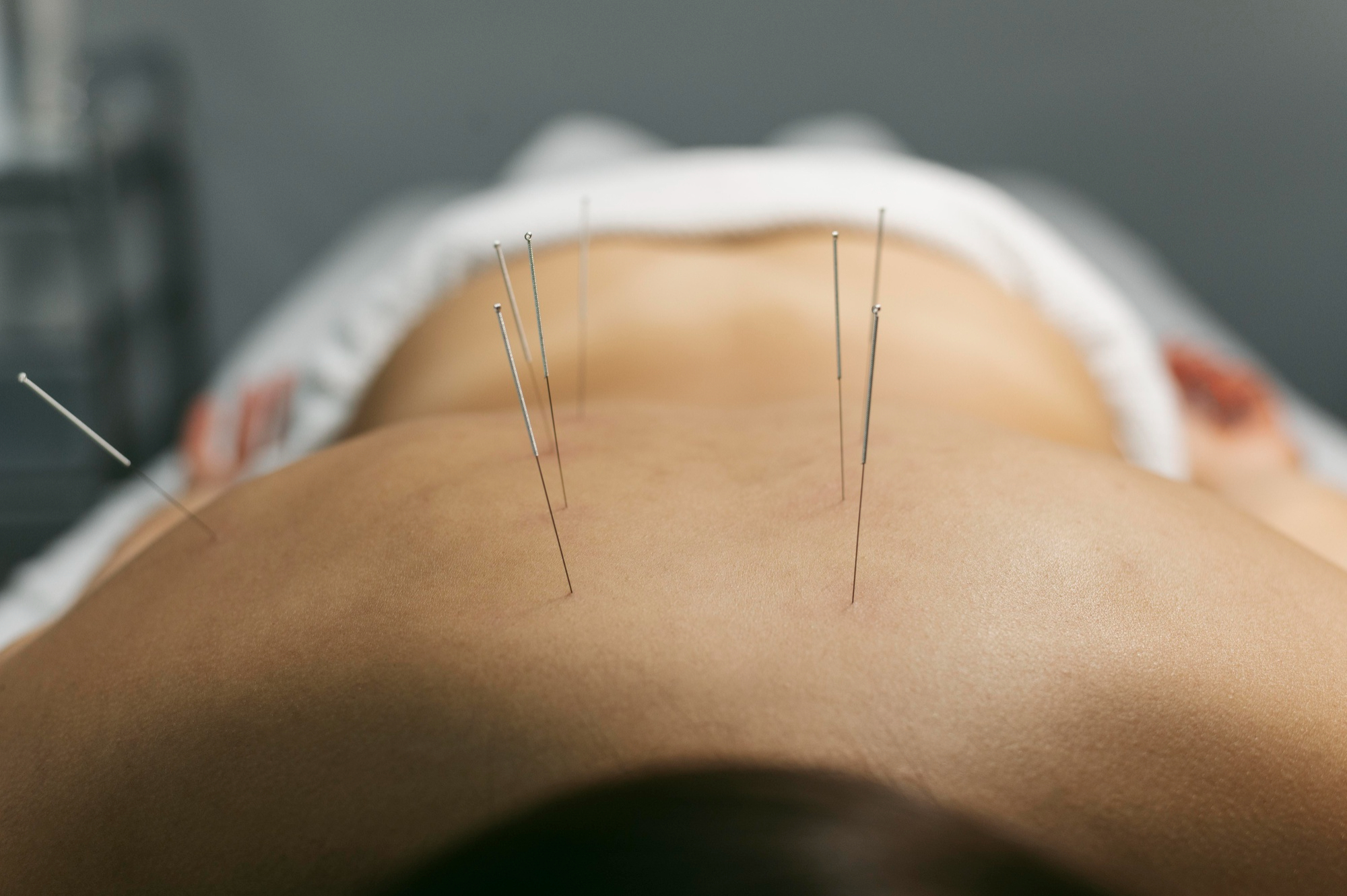 Acupuncture needles placed gently along a patient's back during treatment