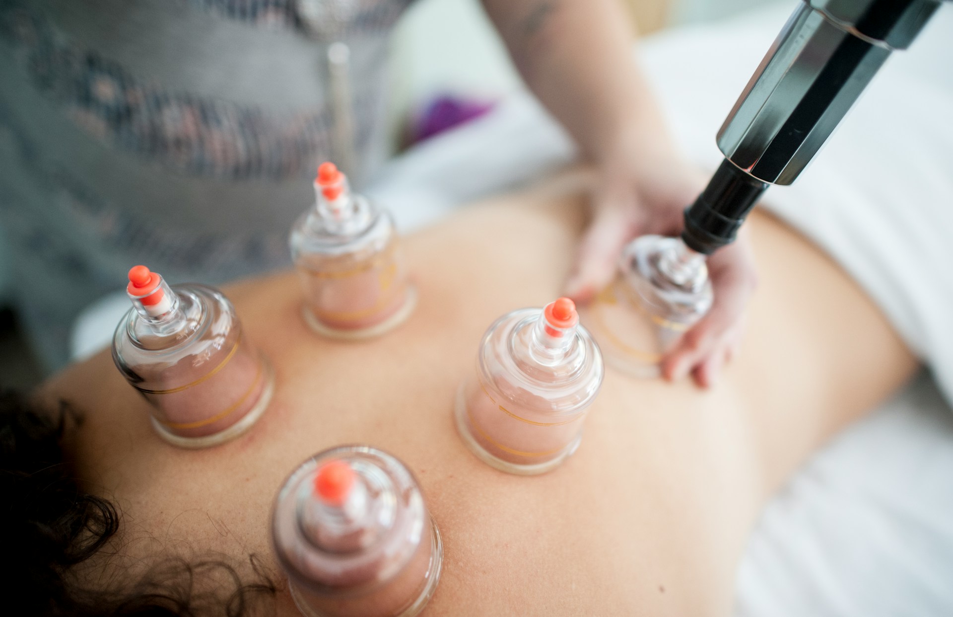 Cupping therapy applied to the upper back in a clinical wellness setting